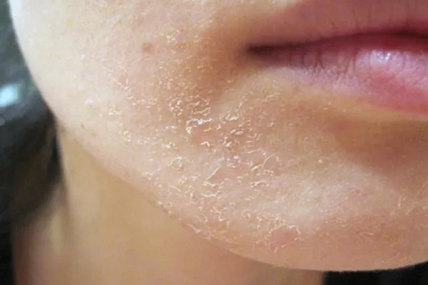 шелушение кожи на лице